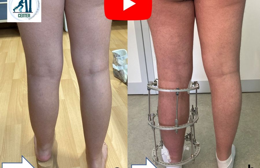Tibia recurvata congenita: allungamento della gamba e correzione della deformità