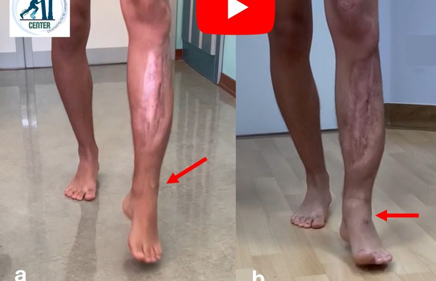 Piede cadente: transfer del tibiale posteriore, 14 anni