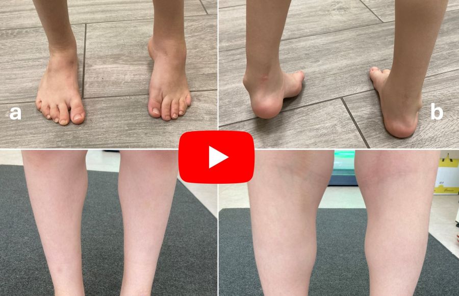 Revisione di Transfer del Tibiale anteriore (dopo precedente fallimento in Svizzera)