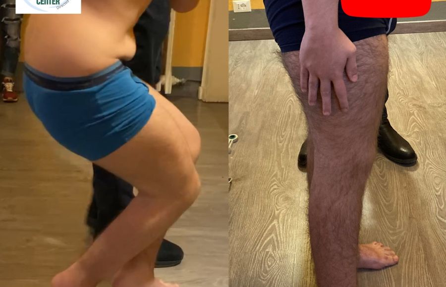 Crouch gait nella Paralisi Cerebrale Infantile: intervento multi-level (14 anni)